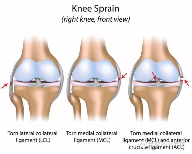 综合 滑膜炎     2,膝关节韧带损伤:膝关节周围韧带较多,有内侧副韧带