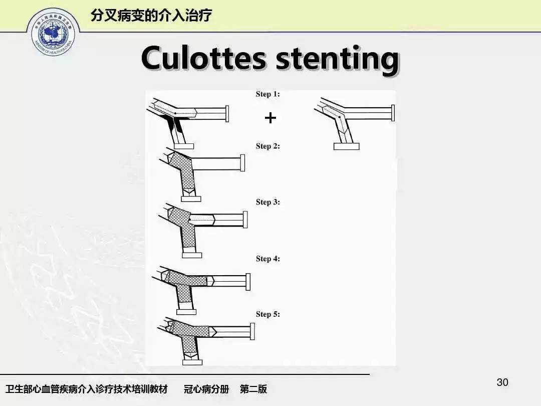 【学术论坛】王中明"浅析冠状动脉分叉病变类型与术式分析"