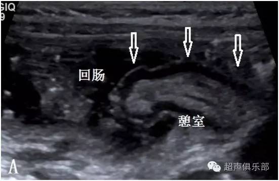 超声医生眼中的梅克尔憩室