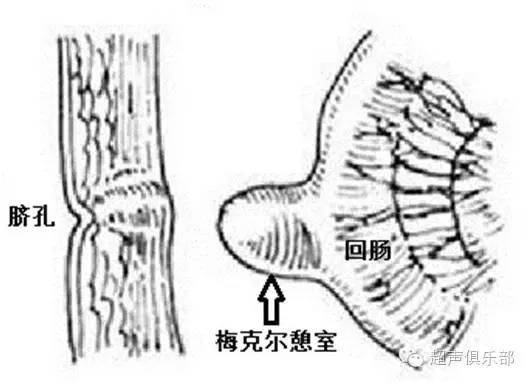 超声医生眼中的梅克尔憩室