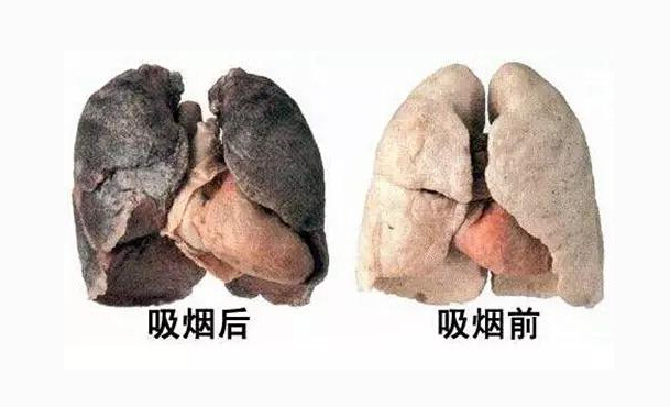 如果查出肺小结节,不要慌,半数都不是肺癌