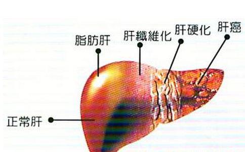 李铁红:肝硬化有哪些症状?中医如何治愈?