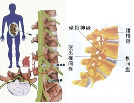 患骨质增生如何治疗?