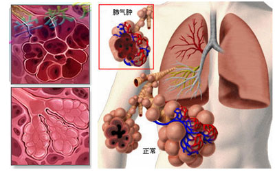 肺气肿是什么病要怎么治疗
