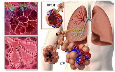 肺气肿患者,远远地看他们,胸部像个桶一样,你知道吗?里面装的全是