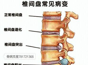 腰椎间盘突出恢复期的治疗方法