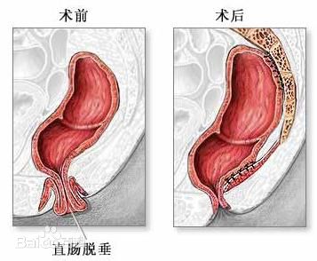 脱肛的特点:直肠粘膜及直肠反复脱出肛门外伴肛门松弛