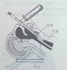 icu必备技能之气管插管 |精选