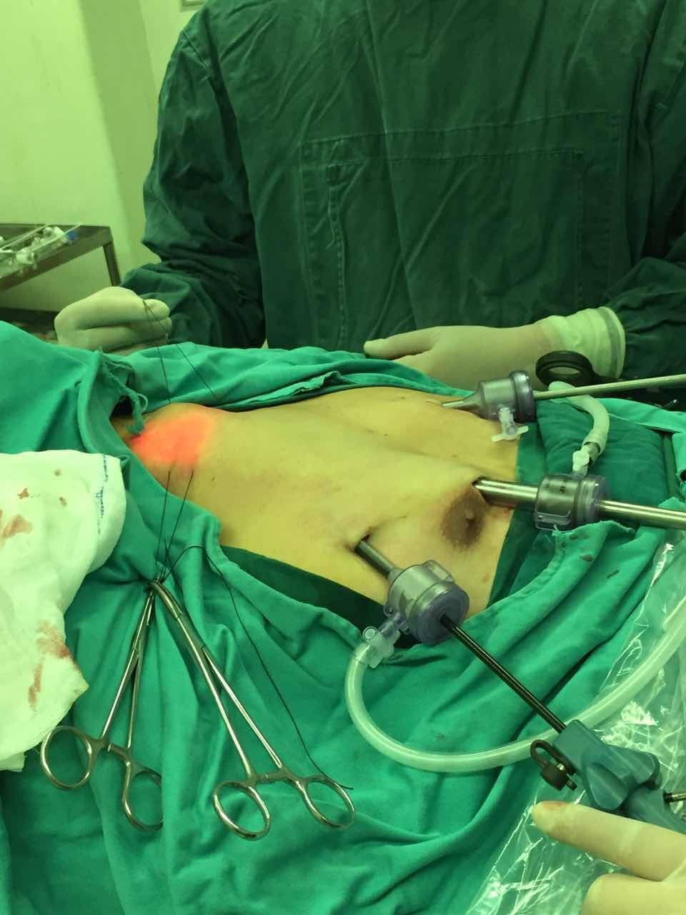 普外科完成我院首例经胸乳入路腔镜下双侧甲状腺次全切除术