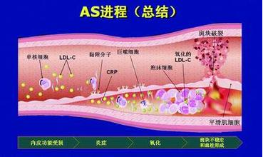 胆固醇免疫方案早实施 动脉硬化可逆转