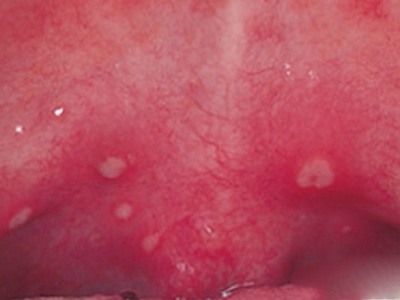 什么是疱疹性咽峡炎?