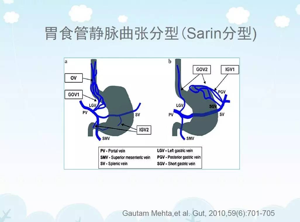 套扎技术在食管胃静脉曲张中的应用