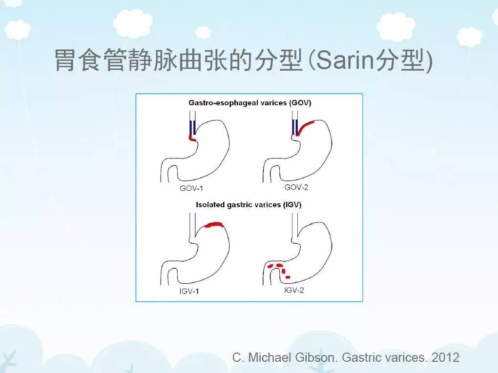 套扎技术在食管胃静脉曲张中的应用