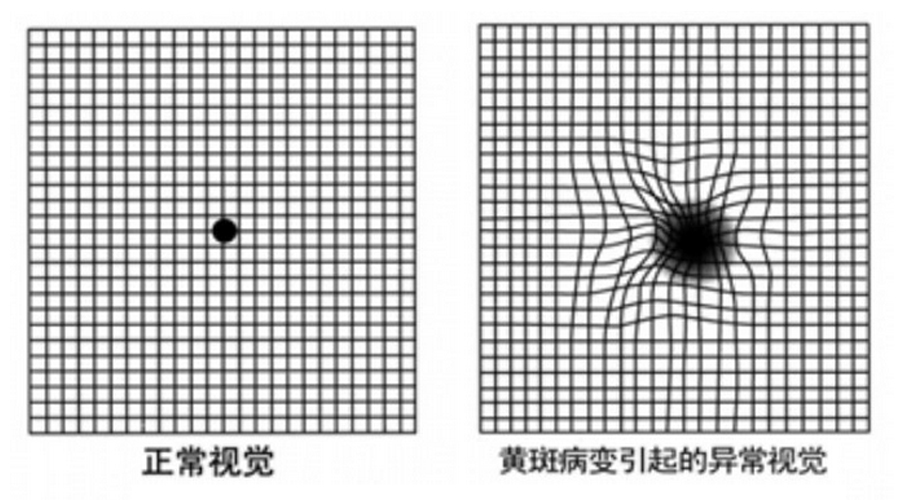 眼底的黄斑为什么容易病变?