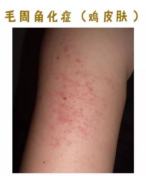 【微提醒】冬天到,手臂大腿布满的红点点究竟是什么?听听专家怎么说