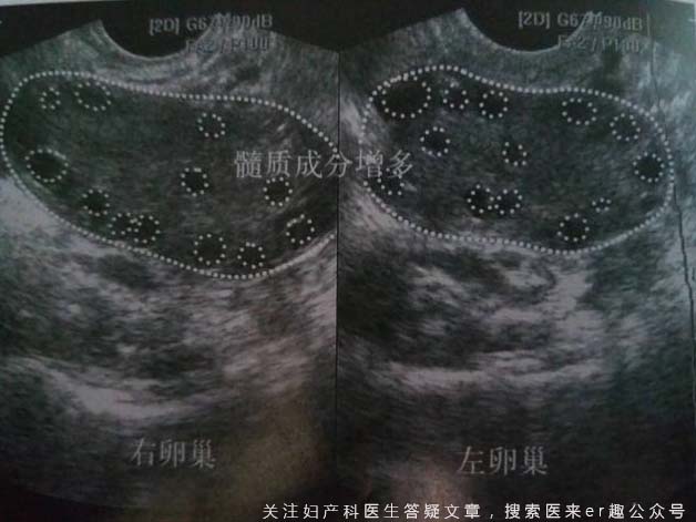 b超图解:常见妇科疾病典型超声表现