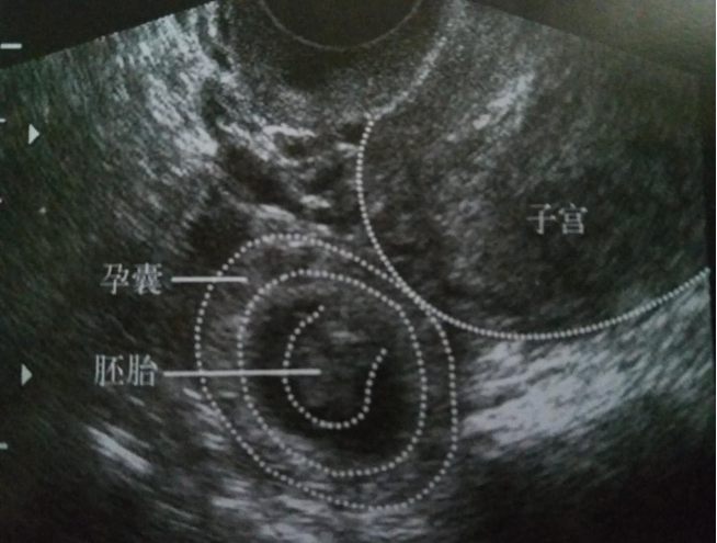 备孕 不孕不育  ②包块型:输卵管已破裂,或已流产,流出的胎囊组织与