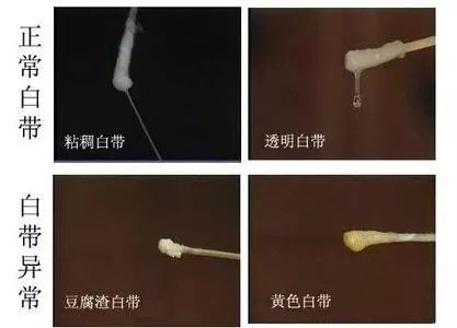 白带是女性身体健康与否的晴雨表,白带异常对女性的危害是不可忽视