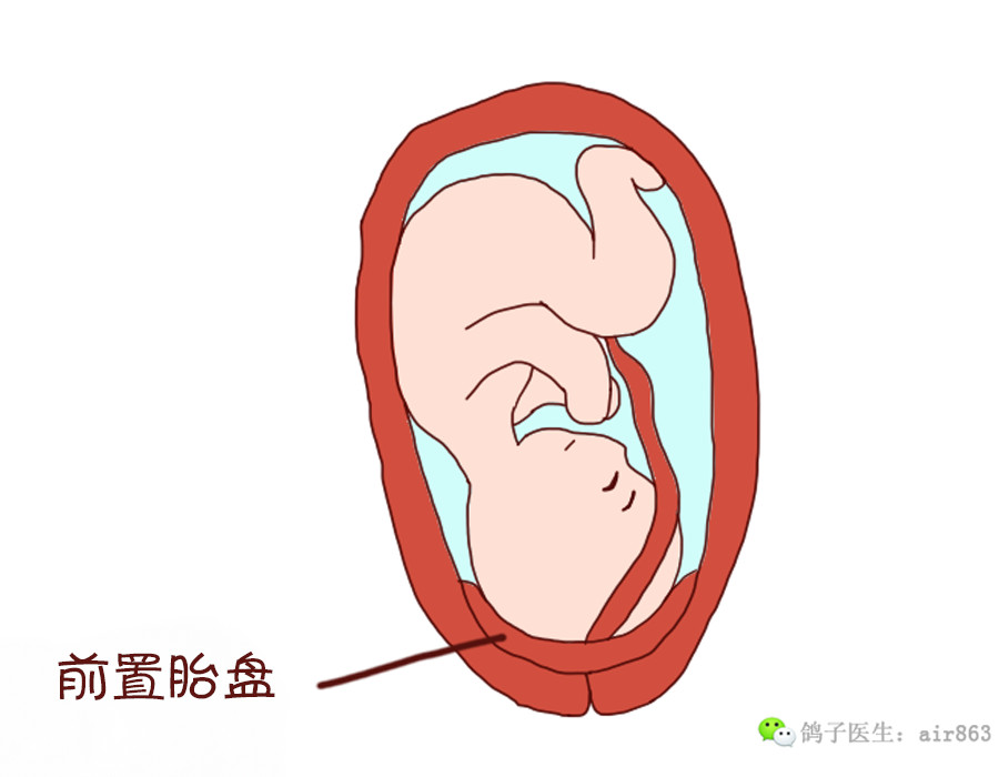 前置胎盘的危害 前置胎盘最常见的就是反复性阴道出血,但出血量的