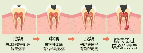 牙齿敏感原来是这些在作祟?