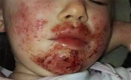 3岁小女孩被亲戚亲了一口后,脸部竟溃烂了一年