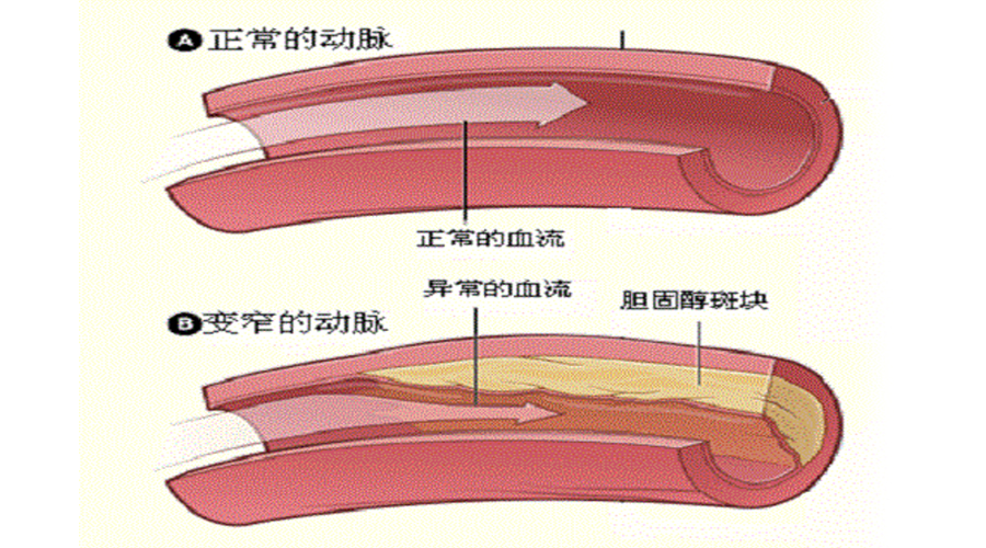 快来看,我们的血管是如何被堵住的!