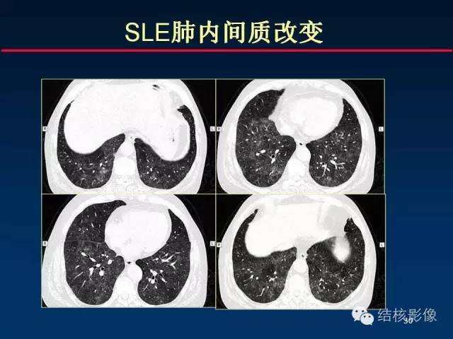 肺间质改变ct的6大征象