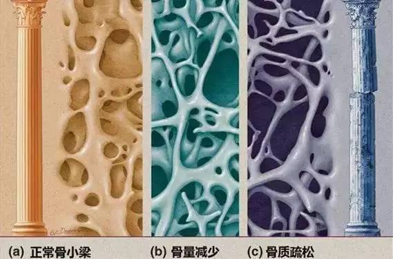 骨质疏松性骨折诊疗指南