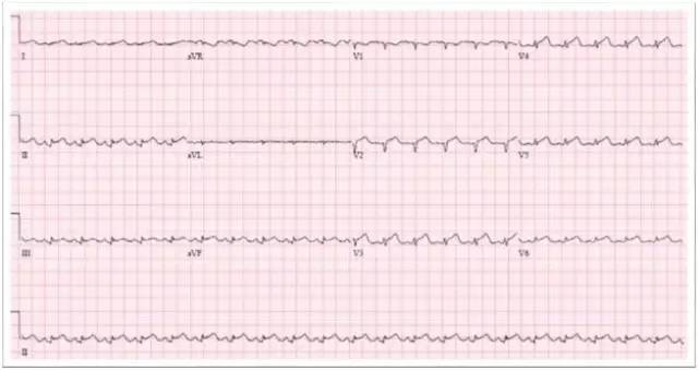 心电图st段抬高还可能是这些病
