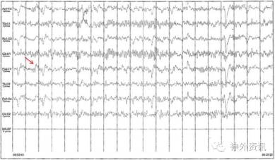 1例头颅血肿钙化所致脑电图异常