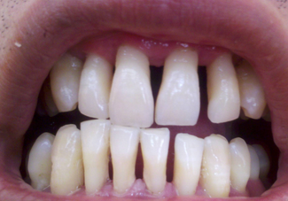 牙龈萎缩的原因和防治
