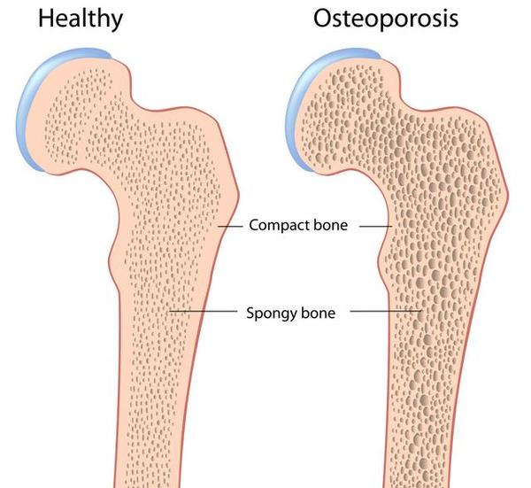 2019骨质疏松症人口_哪些人是骨质疏松高发人群