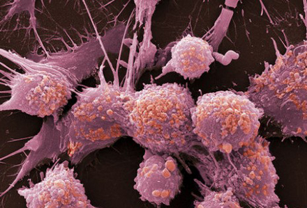 小圆细胞恶性肿瘤的概述