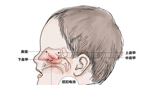 萎缩性鼻炎的典型症状为鼻子干燥,出现脓绿鼻涕和鼻痂,嗅觉减退,头痛