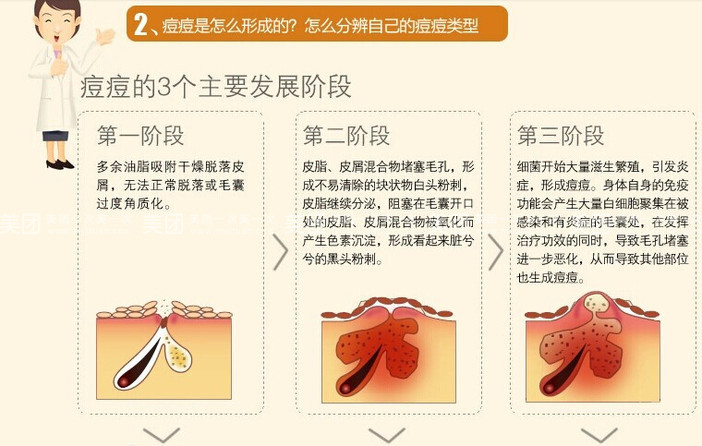 痘痘的生长周期是怎样的答:一般来说痘痘的生长周期分为四个阶段