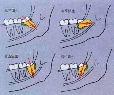 可能影响咬合关系的; 6,阻生齿:埋伏于齿槽骨内的智齿,特别