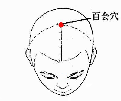 王氏三棱针刺血疗法治疗头痛