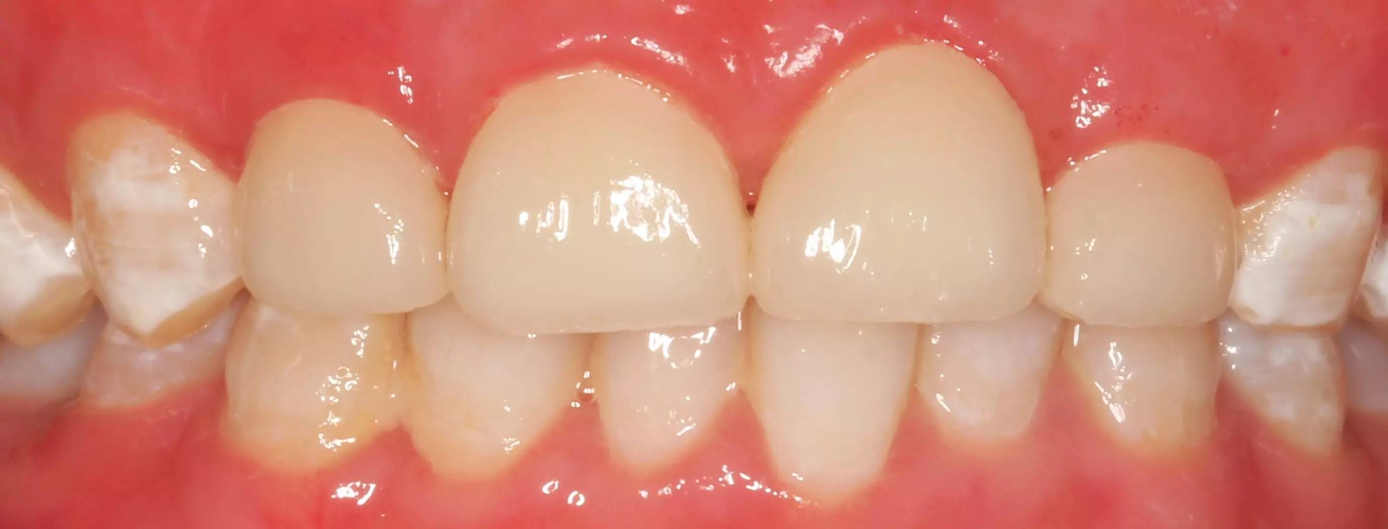 【牙医说第79期】氟斑牙长这样？你的牙齿有这种凹坑吗？_深圳爱康健口腔医院(官网)