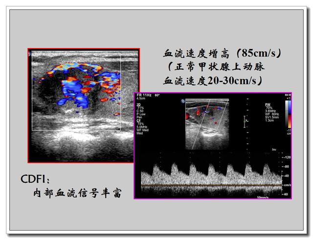 甲状腺超声报告怎么看?