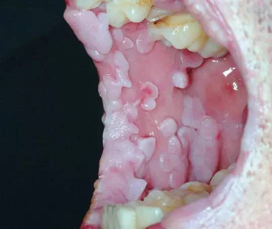 口腔的尖锐湿疣和hpv感染