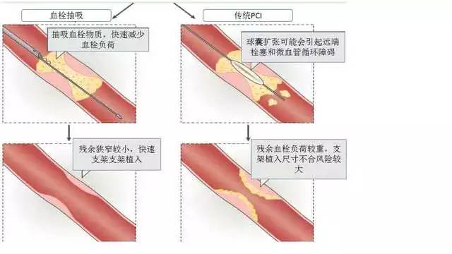 pci血栓抽吸到底配不配