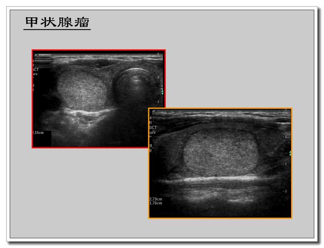 甲状腺超声报告怎么看?