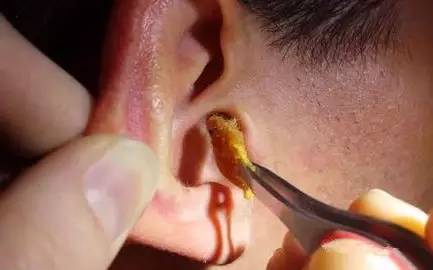 医生从牙龈中挖出矛编个 女子挖出耳屎过程视频