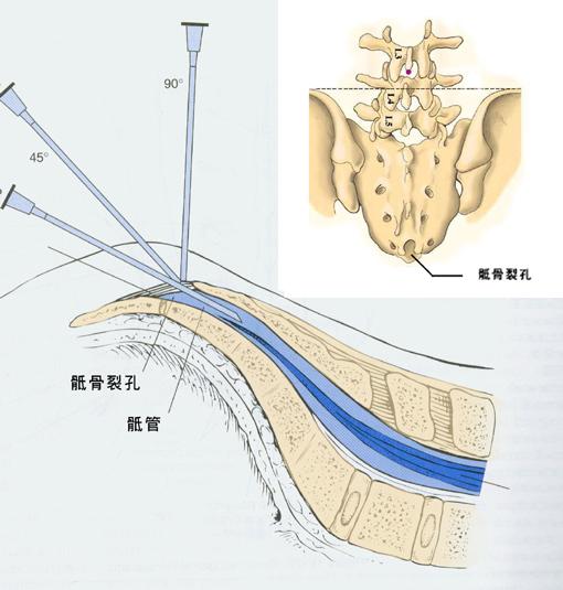 高龄腰椎疼痛可尝试骶管封闭术