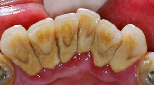 就这样,久而久之,牙齿内侧在长时间得不到清洁,那么就会变得又黄又脏