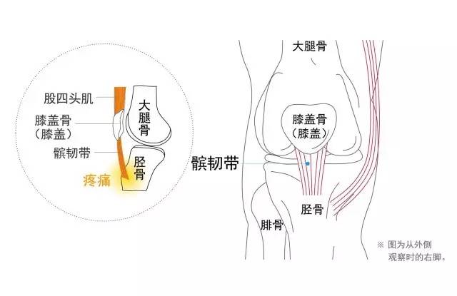 如何解决跑者中常见的膝盖下方疼痛?