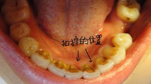 牙齿内侧如果长期不刷后果是这样的附图