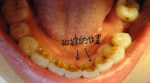 牙齿内侧如果长期不刷,后果是这样的……【附图】