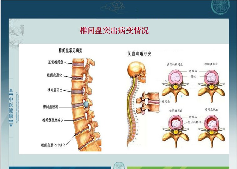 做好4个小动作让离腰间盘突出远离你