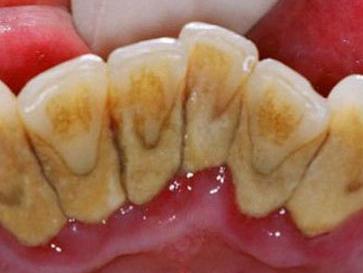 牙齿内侧如果长期不刷,后果是这样的……【附图】